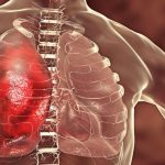 Tingkatkan Kekebalan Tubuh Lansia dengan Vaksin Pneumonia