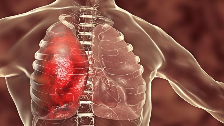 Tingkatkan Kekebalan Tubuh Lansia dengan Vaksin Pneumonia